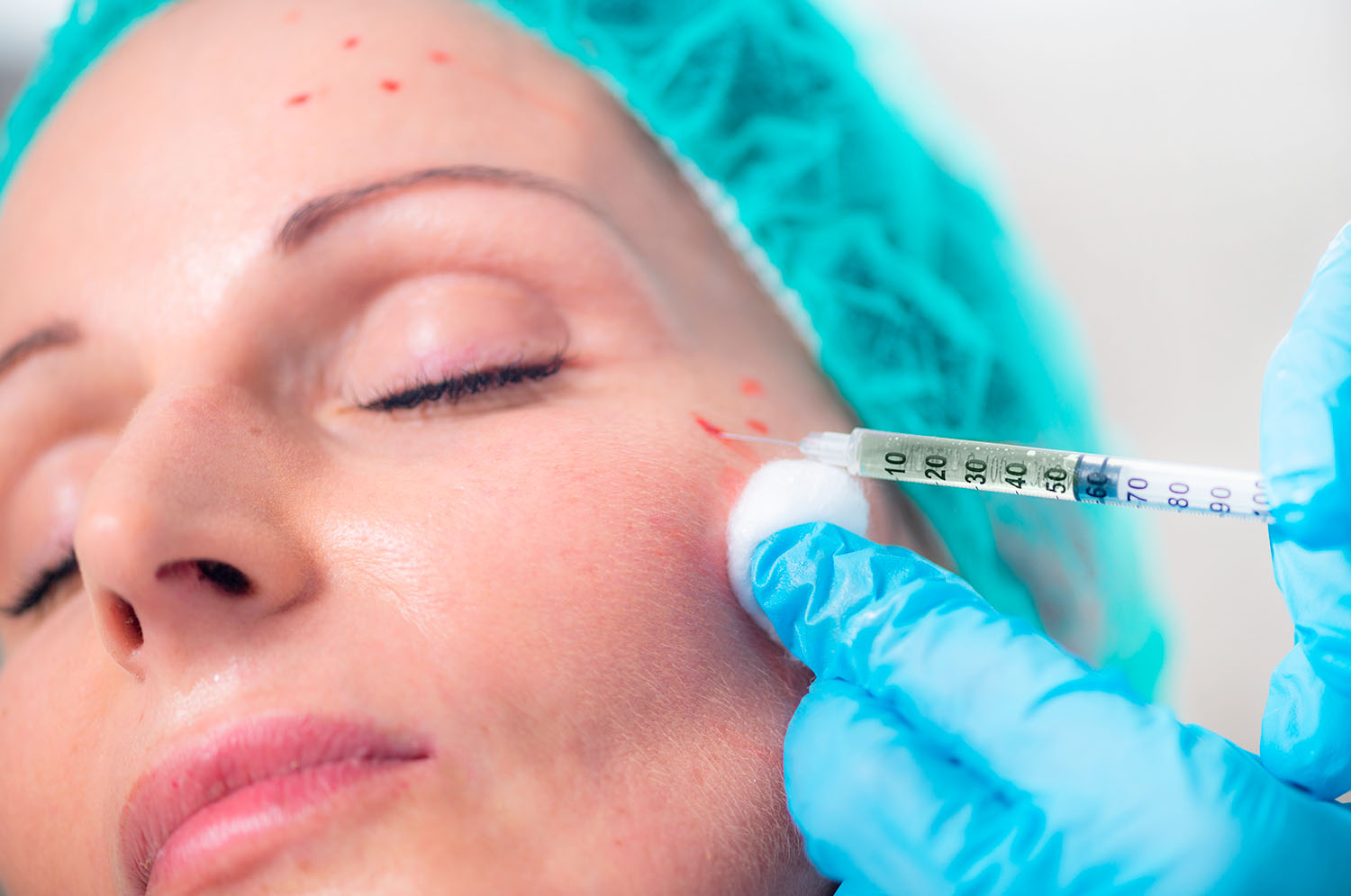 Eine Eigenbluttherapie oder PRP-Behandlung hilft gegen Haarausfall, Hautalterung und Narben.