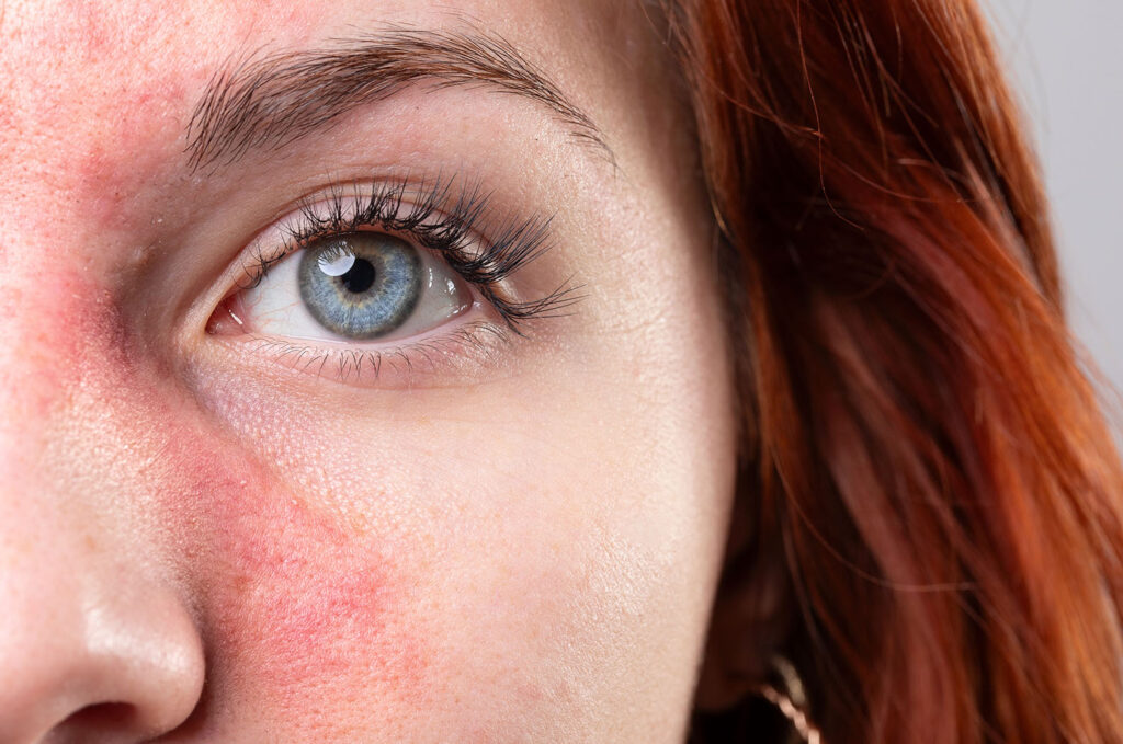 Nahaufnahme einer von Rosacea betroffenen Person mit Rötungen im Gesicht
